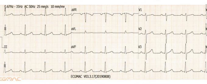 80mm*30m Paper 3 Channel Ecg Machine With 7inch TFT Screen Basic Version 1