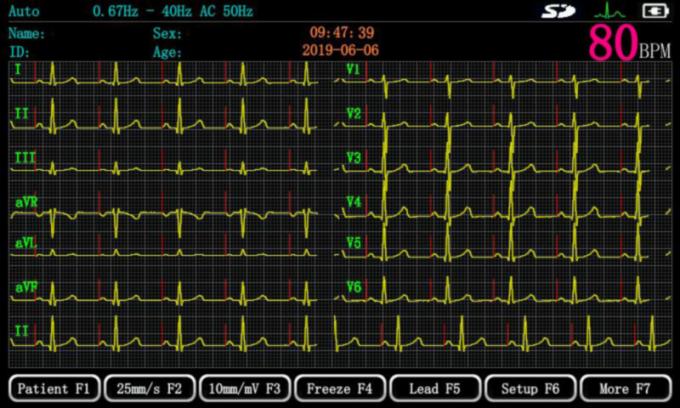 ISO13485 Luxury Version 3 Lead Portable ECG Machine 1