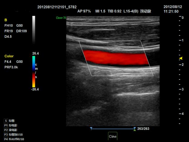 NMPA Andrology Doppler Ultrasound Machine 3D Color IMT BTH-50 9