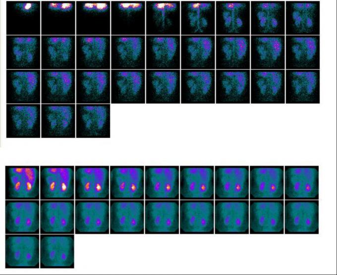 380V Sodium Iodide Nuclear Medicine Equipment Single Photon Emission Tomography 1